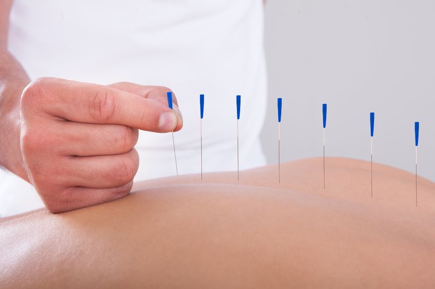 Aiguilles d'acupuncture
